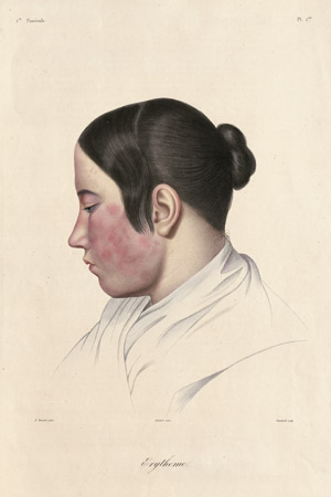 Lot 309, Auction  103, Cazenave, P. L. Alphée, Leçons sur les maladies de la peau professées a l'école de médicine de Paris. 