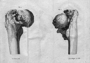 Lot 312, Auction  122, Brünninghausen, Hermann Joseph, Über den Bruch des Schenkelbeinhalses