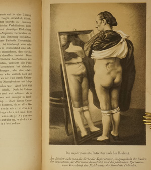 Lot 346, Auction  122, Simon, Gustav, Chirurgie der Nieren, 1. Teil