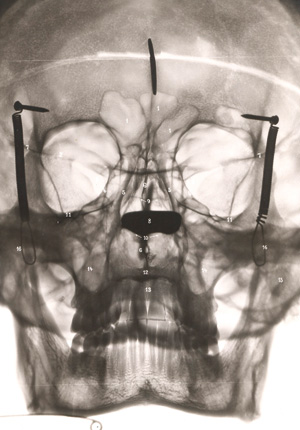 Lot 315, Auction  126, Kuttner, Arthur, Die entzündlichen Nebenhöhlenerkrankungen der Nase im Röntgenbild